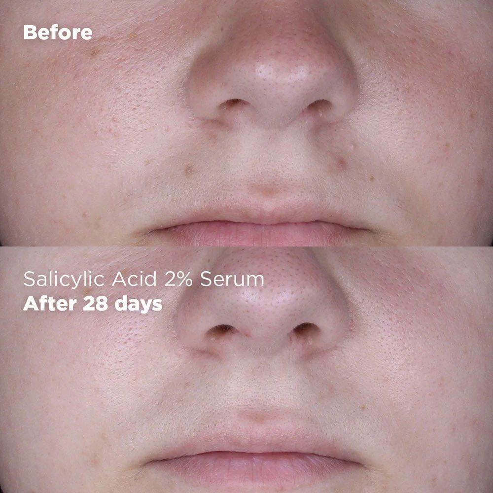 Salicylic Acid 2% Serum -- Gesichtsserum Salicylic Acid 2% Serum -- Gesichtsserum